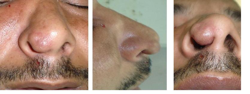 Nasal subcutaneous lipoma, a case report